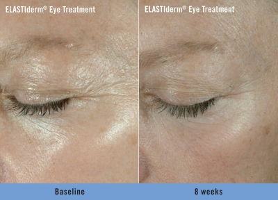 ELASTIderm Eye Treatment